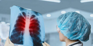 Заболеваемость туберкулезом снизилась в СКО